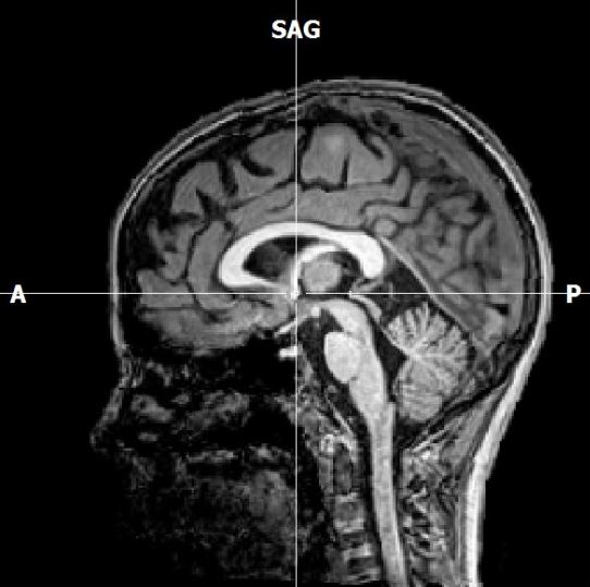 MRI Image of a Human Brain